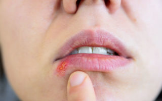 Frau mit Lippenherpes - so kann CBD Öl bei Herpes helfen