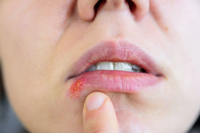 Frau mit Lippenherpes - so kann CBD Öl bei Herpes helfen