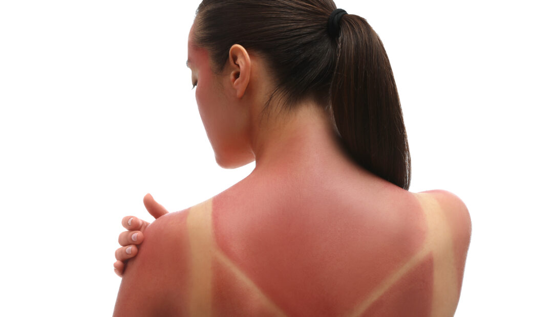 Frau mit Sonnebrand auf dem Rücken